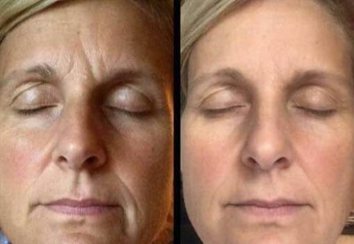 The Techniques For Looking Youthful Via Anti-Aging Face Yoga And Physical Face Lifting goo.gl/lWDvf