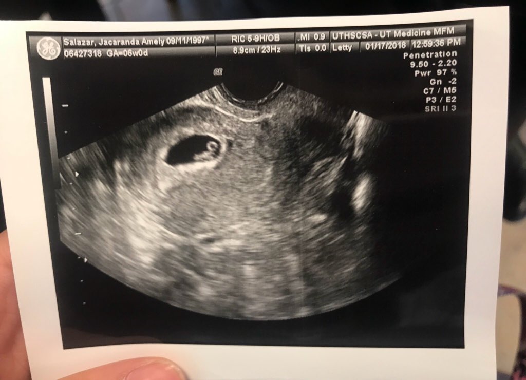 virgo_mamiii's tweet photo. The doctor empathized on the physical pain I’d go through during the miscarriage but not how mentally, it would affect me. My body still thinks Im pregnant. My belly bump is still there but no heartbeat. This is a pain i wouldnt wish on anyone. We love you angel baby���🏽 💜 https://t.co/lrlKb2q2QH