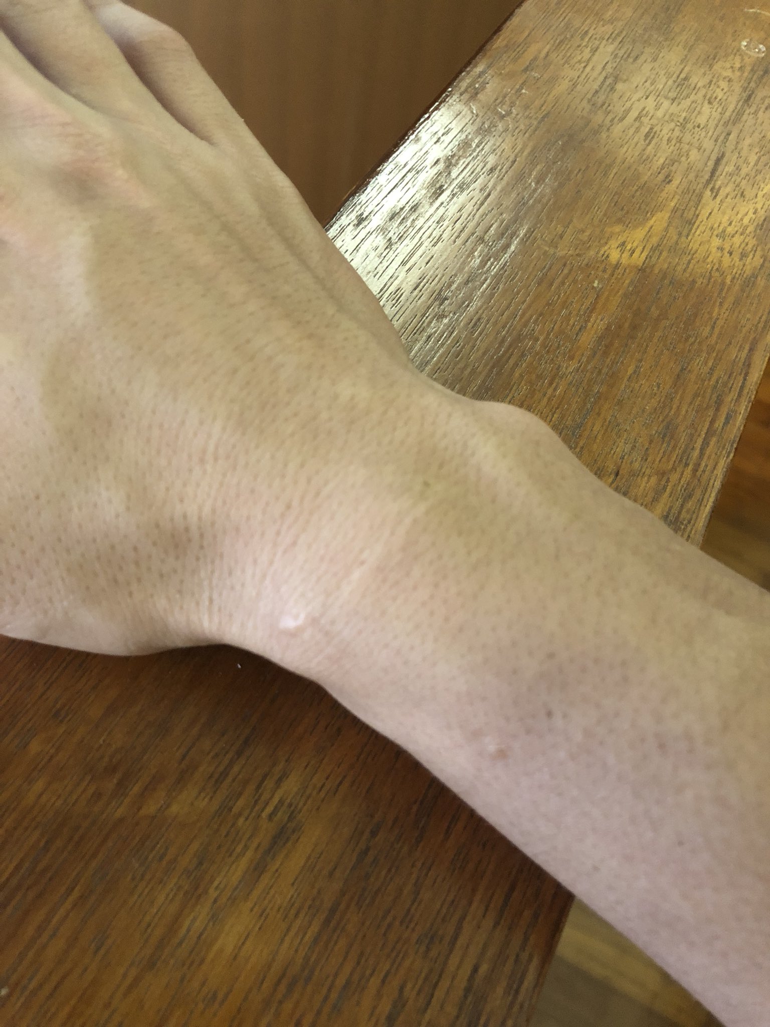 シモジマン 手術痕 ボルト2本 中学時代 複雑骨折 T Co Rzvsmqsmap Twitter