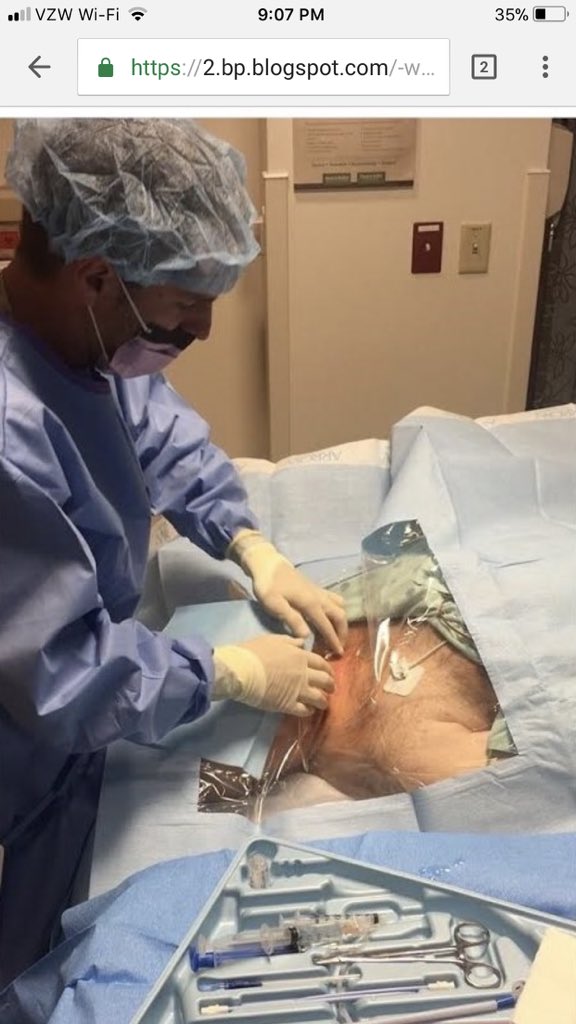 phlegmfighter's tweet photo. We did a “landmark guided” RIJ HD cath like this today. Fellow wanted to see 1, so we put a PGY1 (his FIRST line!) behind the needle with #POCUS on standby. First stick with the “seeker needle” and first pass with the 18ga needle. #oldschool #landmarking https://t.co/fT7rv1Aaks https://t.co/4lJ5B6Z7PA