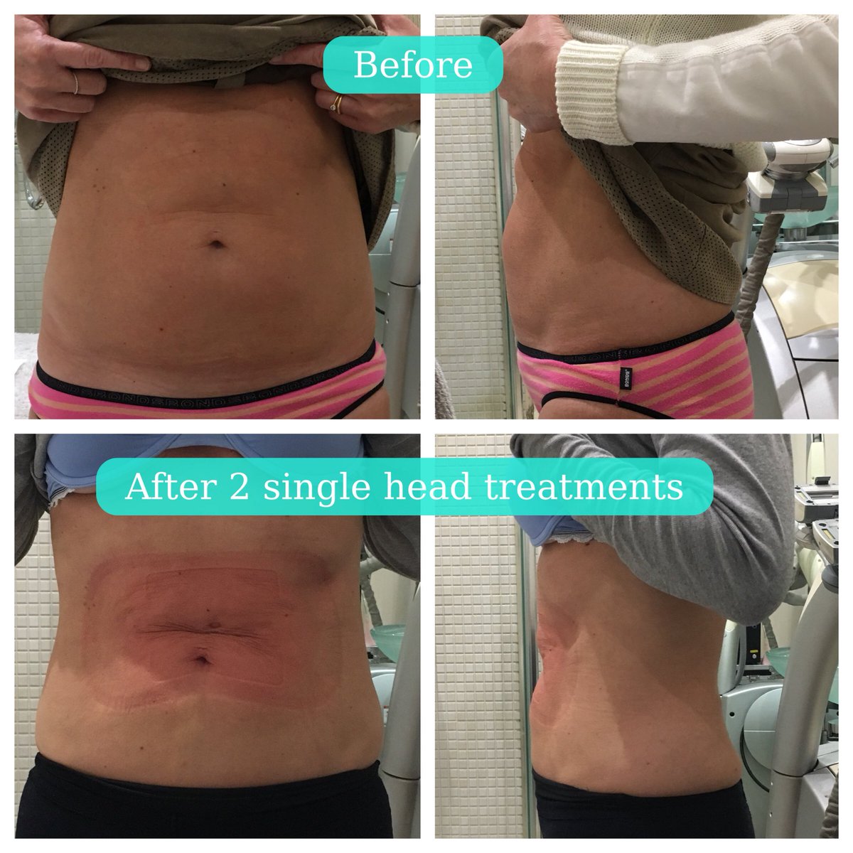 SimplyFatFreeze's tweet photo. Get the body you want, book your fat freezing bundles today on 07391 443621 and save pounds as you lose kilos https://t.co/sRrA88RKX5 https://t.co/1CeEkjlSpI