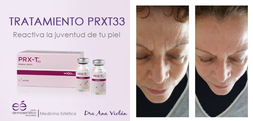 DermoCanteras's tweet photo. ✅CASO REAL✅PRX-T33 es un nuevo concepto de medicina antienvejecimiento y biorrevitalización. Consulta con la Dra Ana Violán y empieza ya a lucir tu mejor cara #prxt33 #tratamientosfaciales #antiging #fotoreal #sinfiltros https://t.co/PW8cpgkhru https://t.co/vNcsamDUfN