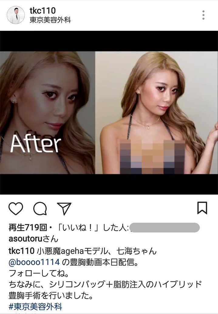 Tkc 公式 東京美容外科 小悪魔agehaモデルの七海さん Boooo 盛りました 動画は小野院長のインスタグラムから配信中 小悪魔ageha 豊胸 T Co A0zvk5fzec Tkc 公式 東京美容外科 小悪魔agehaモデルの七海さん Boooo 盛りました 動画は小野院長のインスタグラムから配信中 小悪魔ageha 豊胸 T Co A0zvk5fzec