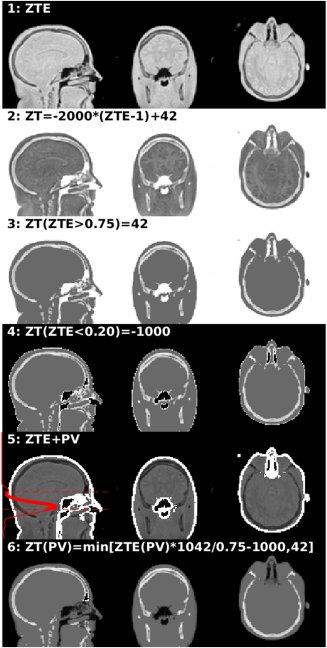 ZTE #MRI for accurate #PETMR attenuation correction and MR-guided radiation therapy planning.  Next generation methods will combine high quality ZTE data with deep learning for automatic pseudoCT/syntheticCT generation 
free view: rdcu.be/HCH6/
onlinelibrary.wiley.com/doi/10.1002/mr…