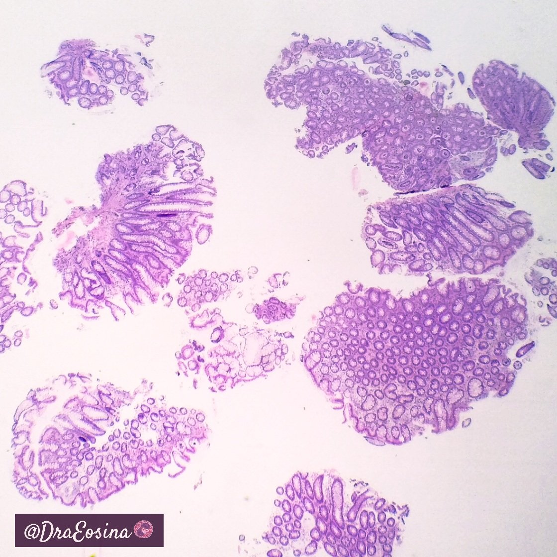 Laura G. Pastrián MD on Twitter "Lesson number two 'Crush' artifact