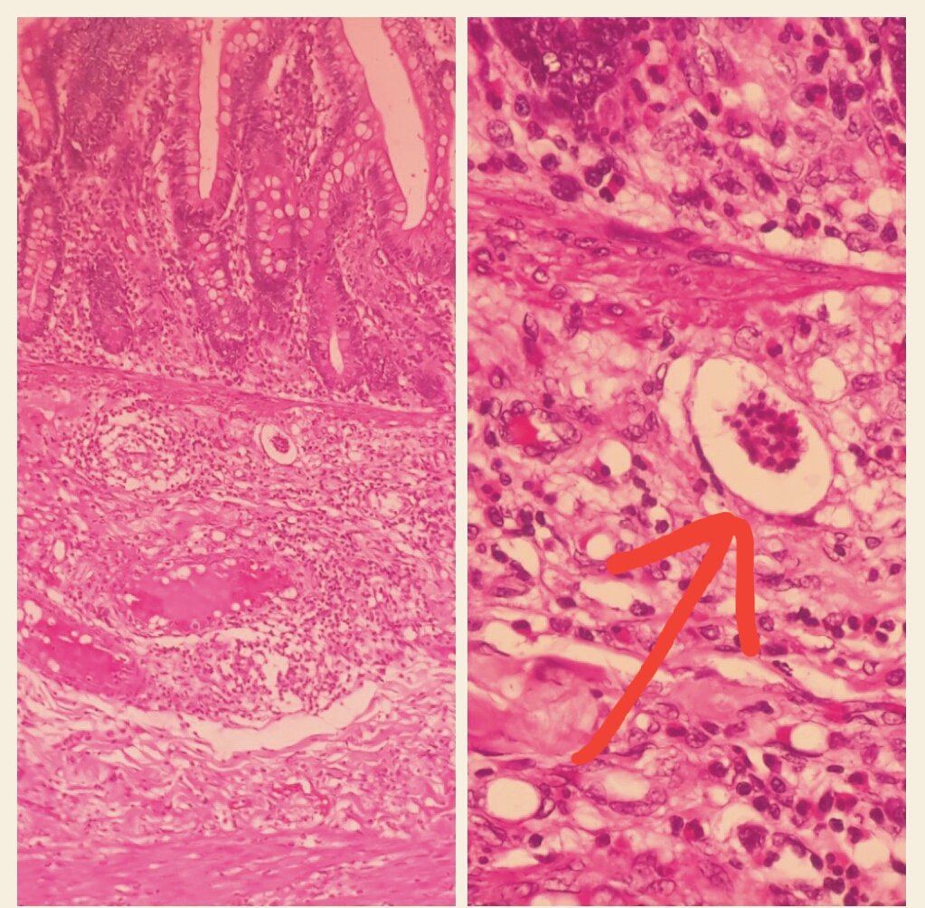 Angiostrongylus costaricensis. Eggs