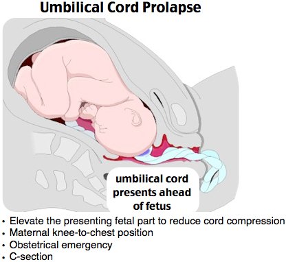NachiGupta's tweet photo. Ep 42 of @Roshcast: Korsakoff Syndrome, AAA, Prolapsed Umbilical Cord, Epiglottitis, Thoracostomy, Intracerebral Hemorrhage
https://t.co/Zk3x3J7ORe
https://t.co/kjhepF6RkV
#FOAMed https://t.co/uFIMawg3pJ