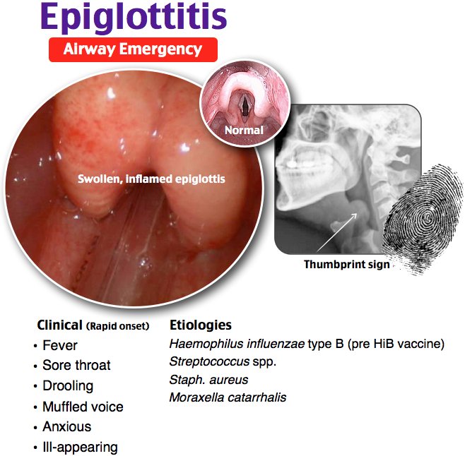 NachiGupta's tweet photo. Ep 42 of @Roshcast: Korsakoff Syndrome, AAA, Prolapsed Umbilical Cord, Epiglottitis, Thoracostomy, Intracerebral Hemorrhage
https://t.co/Zk3x3J7ORe
https://t.co/kjhepF6RkV
#FOAMed https://t.co/uFIMawg3pJ