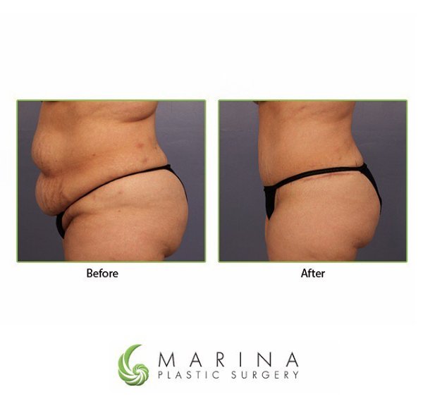 DrGrantStevens's tweet photo. Amazing #BeforeAndAfter results by @DrLuisMacias w/ #DrainlessTummyTuck + #Liposuction. I will be discussing more at the American-Brazilian Aesthetic Meeting / #ABAM2018 this weekend. 

#Brazil #PlasticSurgery #ASAPS #CosmeticSurgery #ABAM18 #Florianopolis #ABAM #NoDrainTummyTuck https://t.co/AzbN3VhRJR