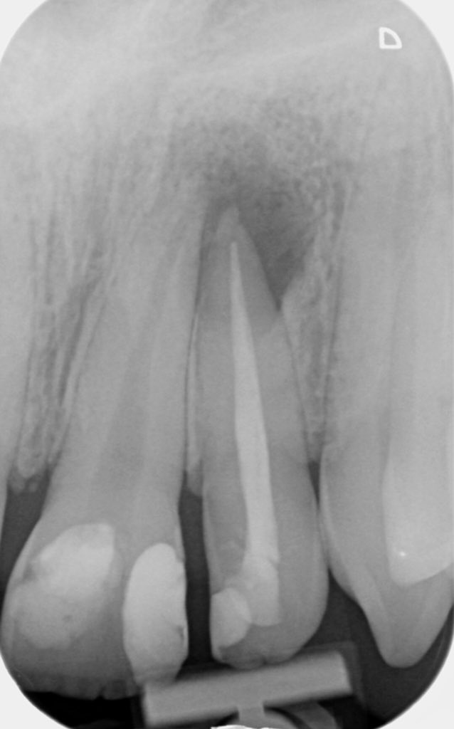 rootcanaluk's tweet photo. Happy Friday!! On review, healing ongoing in this trauma case of retreatment UL2 and primary treatment UL1 !! #endodontics #rootcanalclinic #dentaltrauma #savingteeth #dentistry #LyndonMeehan https://t.co/fZc6ZXbYNV