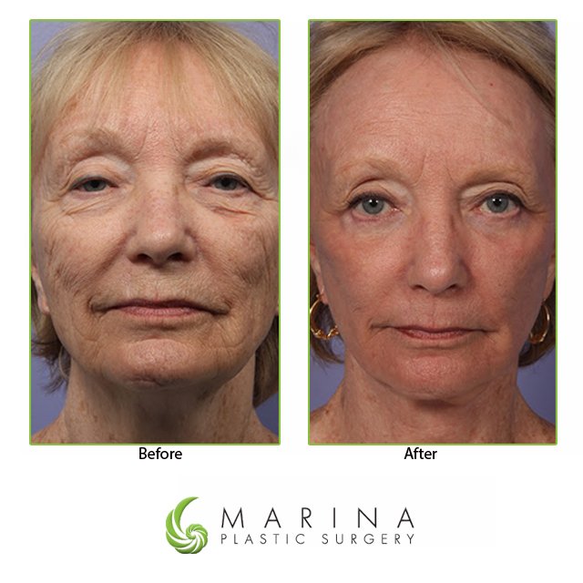 DrGrantStevens's tweet photo. Check out these amazing #BeforeAndAfter results with a #FaceLift, BBL and #Fraxel.  

#ABAM #DrGrantStevens #MarinaPlasticSurgery #MPSA #IcingOnTheCake #Restore #ABAM2018 #SkinCare #Tighten #Rejuvenation #FridayFeeling #FlashbackFriday #Aesthetics https://t.co/LY5iPr3f84