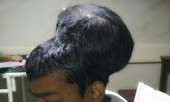 Jessi_Crane_'s tweet photo. Worlds biggest brain tumor? #rhsmbs Santial Pal from India https://t.co/NFoK4mCfUh