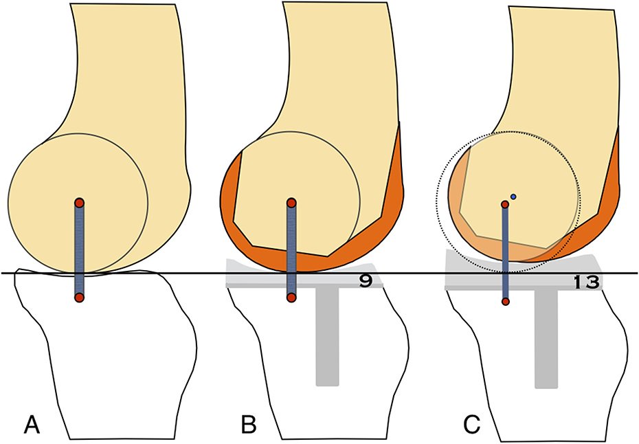Raising the Joint Line in TKA is Associated With Mid-flexion Laxity: A Study in Cadaver Knees ow.ly/iiab30izupB
