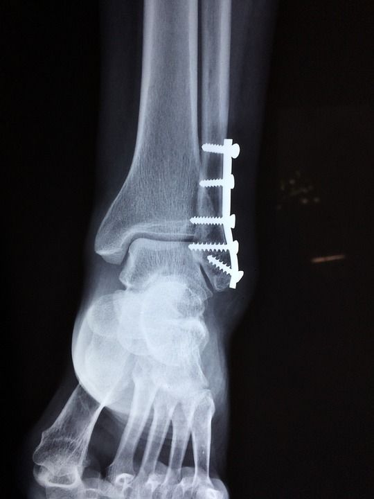 TroyBiologicals's tweet photo. Are you at risk for a stress fracture?
https://t.co/x1baJW1gXZ
#TroyBiologicals #TroyBio #Microbiology #StressFracture #SportsInjuries https://t.co/oQPUtVAeo2