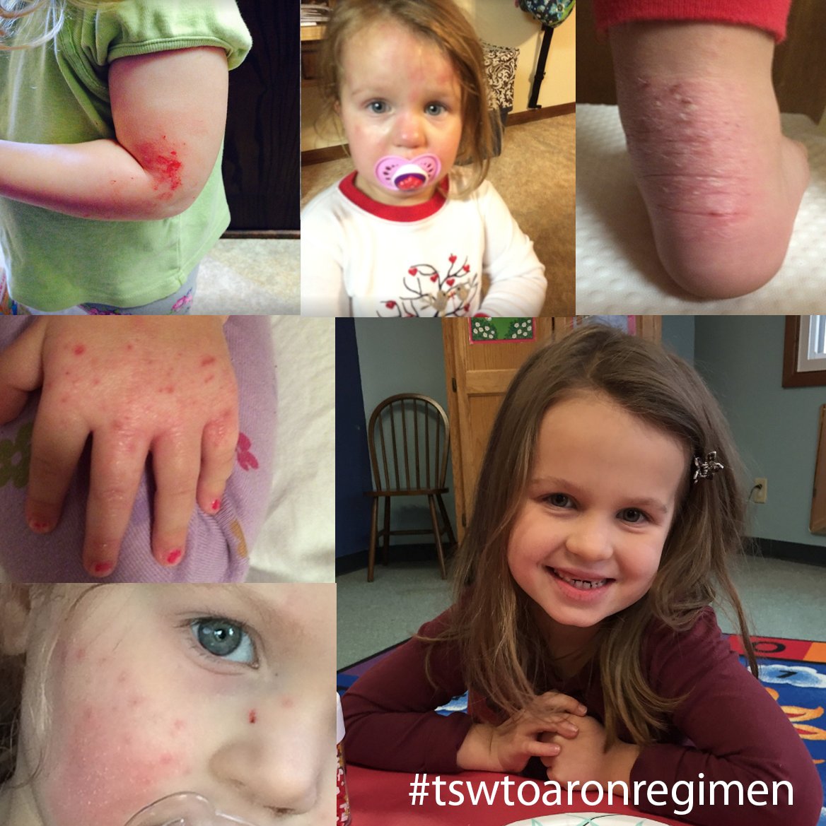 etsinmods's tweet photo. 15 months tsw vs Aron Regimen   https://t.co/TeJeeuxW2T   #redskinsyndrome #topicalsteroidwithdrawal #topicalsteroidaddiction  #tswtoaronregimen #DrAronremission #eczema https://t.co/H1e9x1JW6T