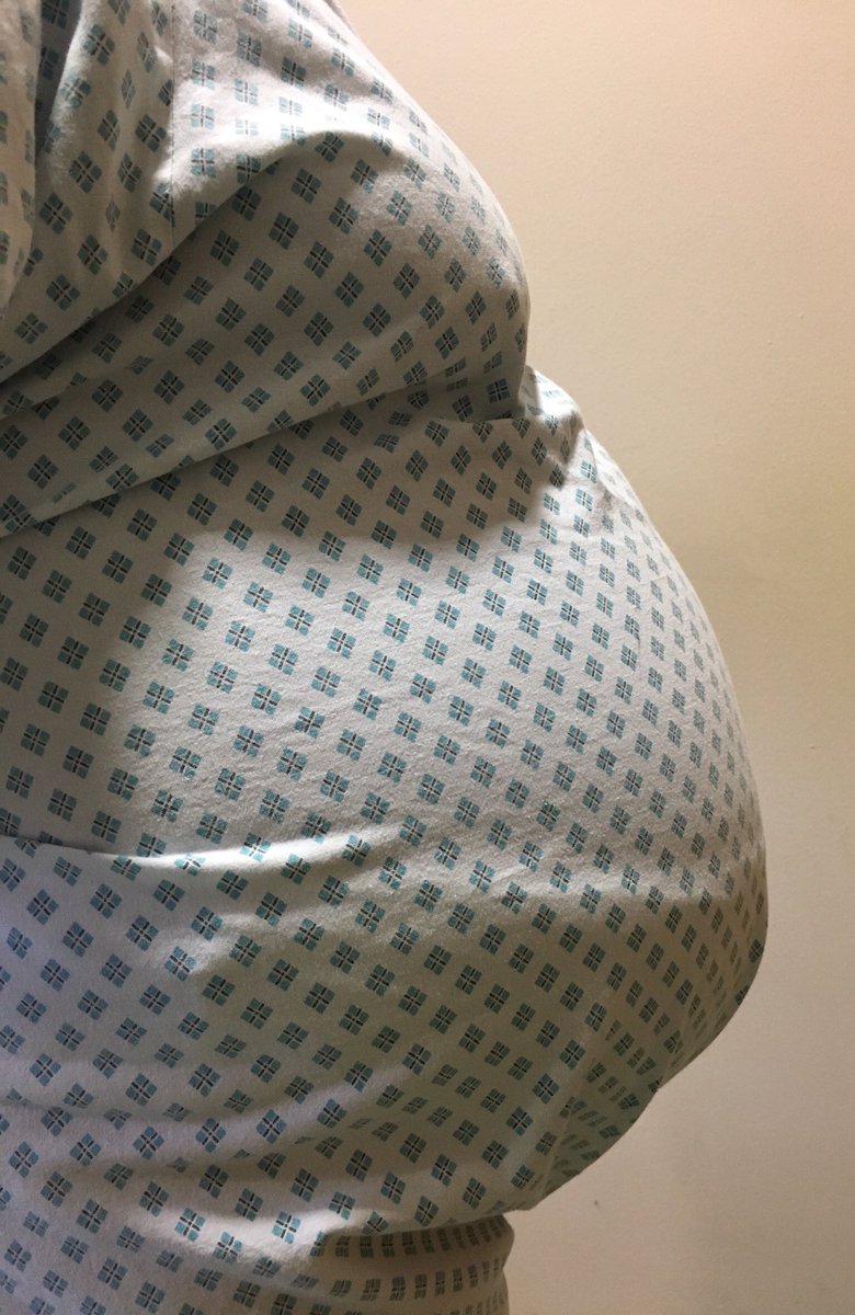 Rasel Mahbub (@rasel2024) on Twitter photo 9 months Pregnant?No! Swollen tummy for 8 days, failed & unwilling to do proper diagnosis to find the cause!@NewhamHospital <a href="/NHSBartsHealth/">Barts Health</a> 9 months Pregnant?No! Swollen tummy for 8 days, failed & unwilling to do proper diagnosis to find the cause!@NewhamHospital <a href="/NHSBartsHealth/">Barts Health</a>