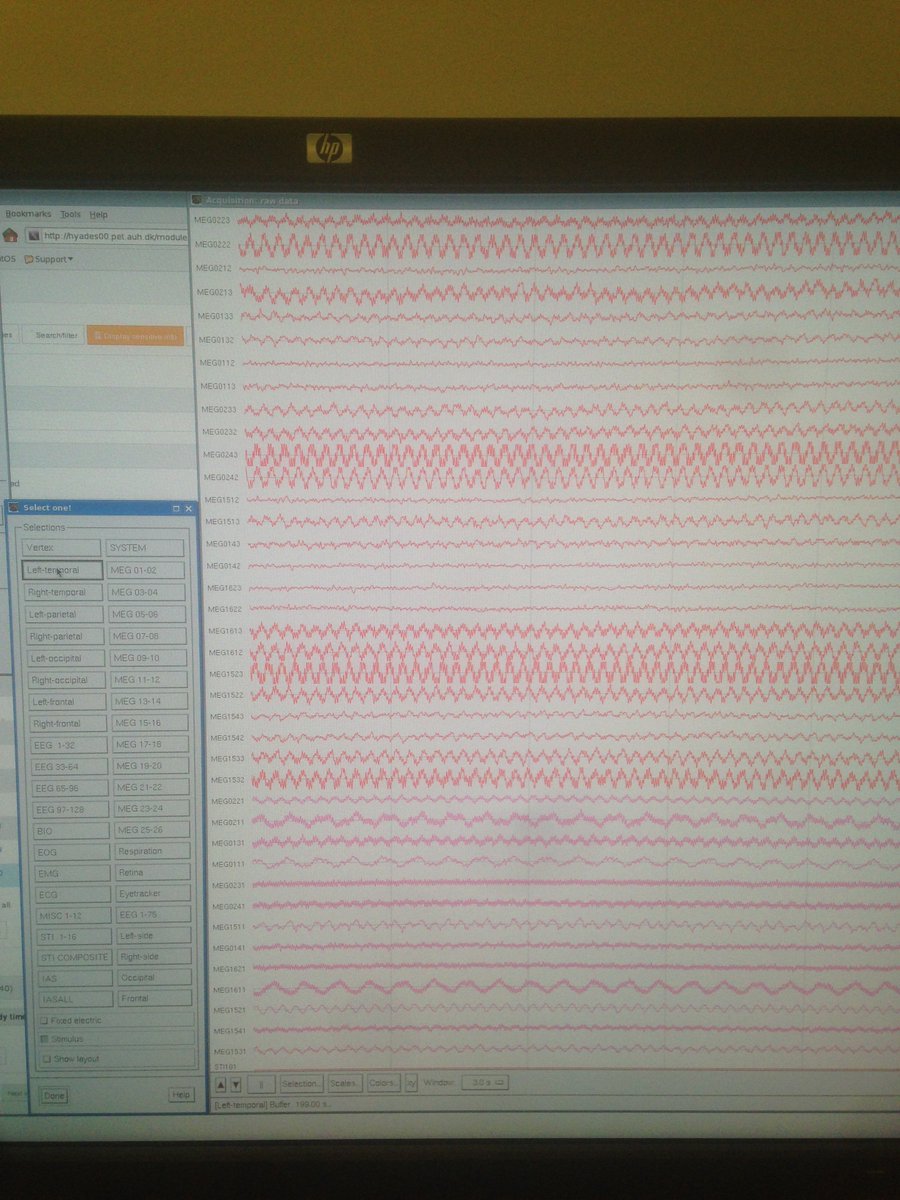 ahoejlund's tweet photo. @AarhusUni @AUHdk In case you're wondering, #MrMelon is plugging away at it tirelessly - here receiving stimulation at 5V (@ 60 µs and 130 Hz), this is clearly visible on the raw #MEG signal. #ANightAtTheLab https://t.co/VPGggugaZm