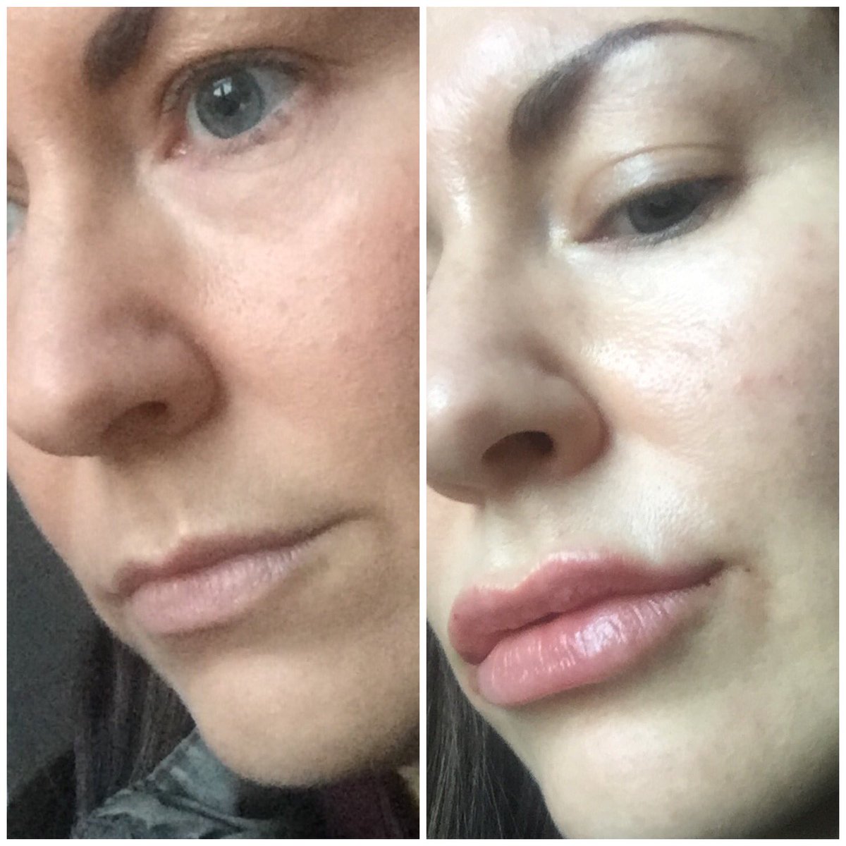Kate Jackson (@strictlybook) on Twitter photo Sooo happy with my aesthetic treatment of forehead Botox & lip fillers 2day by Kath Cumberland <a href="/harleyskinlaser/">Harley Skin & Laser</a> lovely lady & of course amazing salon of Harley’s...here’s my results so far (swelling to go down!) 😍👌🏻 Sooo happy with my aesthetic treatment of forehead Botox & lip fillers 2day by Kath Cumberland <a href="/harleyskinlaser/">Harley Skin & Laser</a> lovely lady & of course amazing salon of Harley’s...here’s my results so far (swelling to go down!) 😍👌🏻