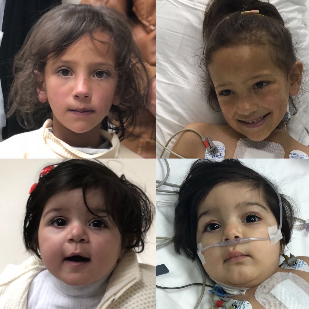 Cooperation in cardiac surgery is effective &amp; affordable. Before&amp;after relief of various forms of cyanotic congenital heart disease in syrian refugees with <a href="/chainedelespoir/">La Chaîne de l'Espoir</a> <a href="/eu_echo/">EU Civil Protection & Humanitarian Aid 🇪🇺</a>