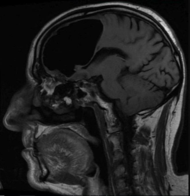 crown_valley's tweet photo. “Man's 'Missing' Brain Was Actually a Large Air Pocket Inside His Head” via https://t.co/DSLVawwBSU #brain #missingbrain #head #imaging https://t.co/G8Wc1L0TOG