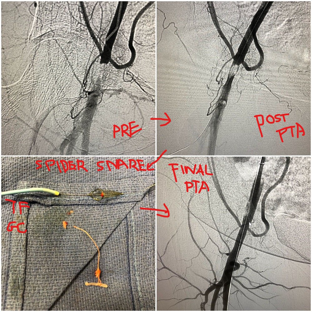 LIVE <a href="/MountSinaiNYC/">Mount Sinai Health System</a> #IRad:  Claudication post Y90 - Angioseal injury

<a href="/Medtronic/">Medtronic</a> Spider "filterwire snare technique"  and 7F Guidecath removal of plug and PTA

#RadialFirst #withoutascalpel #gettheplugout <a href="/bonesz/">Aaron Fischman MD | Interventional Radiologist</a>  <a href="/AlanBirneyMD/">Alan Birney</a>