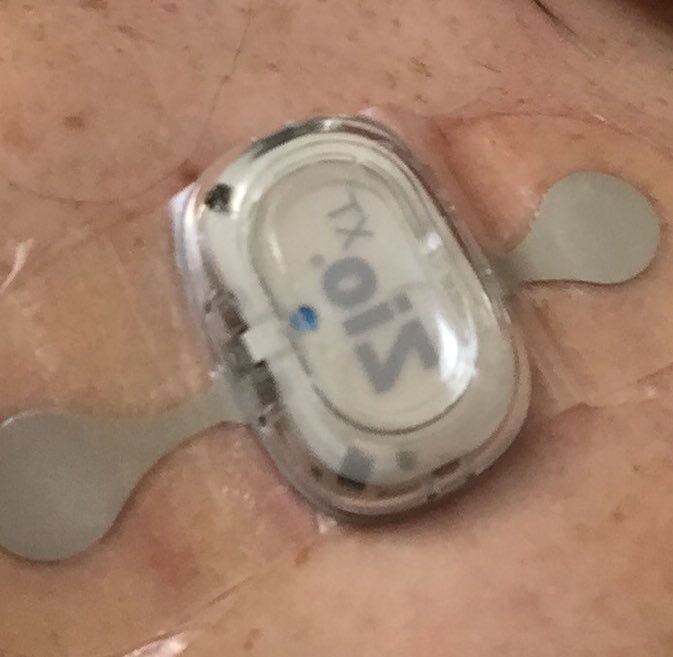 chronicallyfab1's tweet image. The itch struggle is fucking real with this monitor. And I have 11 more days with it on. Antihistamines aren’t helping. Argh #chroniclife