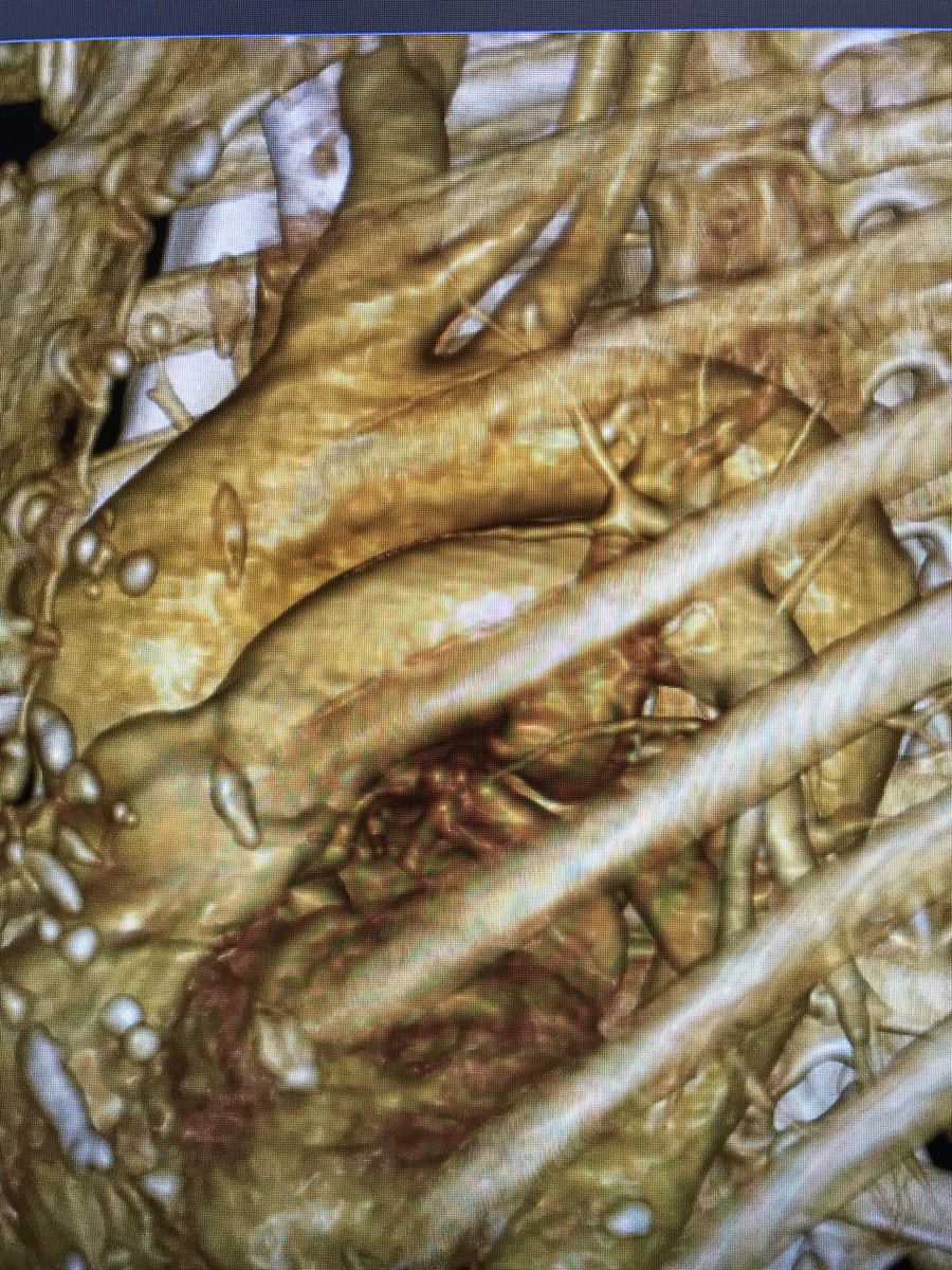 CharlieMonitor's tweet photo. Cost effective 3D flexible model of a healthy Aorta used as a reference guide during surgery printed at @3d_maranon. @rupermac @calvoharo_ja @3DGabBME @BiomedEstefania @BiomedAdrian https://t.co/Grnt2yAekB