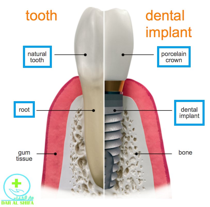dar_center's tweet photo. >Minimum failure rate &amp; Free replacement in case of failure

Book your appointment now:
Inbox 📩 or call ☎ 021-35171191
https://t.co/jKb0aeCUcI

#dentistry #dentalcare  #DentalHealth https://t.co/QVnGuoo1C6