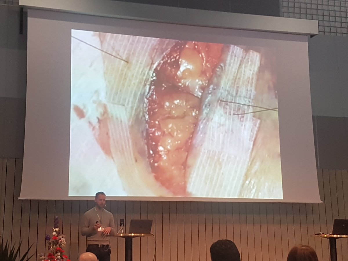 SWESEMjr's tweet photo. Har patienten ett sår där huden är skör och suturtråden skär igenom den? Förstärk huden med steri strip och sy igenom tejpen!
@FOAMedup på #Sweets18
#SWESEM #SWESEMjr https://t.co/aPJDI6cuDW