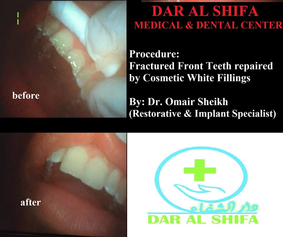 dar_center's tweet photo. "Cosmetic Fillings done to repair Fractured Front Teeth"

For more info &amp; appointments:
https://t.co/jKb0aeCUcI
Tel: 021-35171191

#COSMETICS  #Dentist #dentalcare #dentalhealth #DentalHygiene https://t.co/vdzdt45aBb