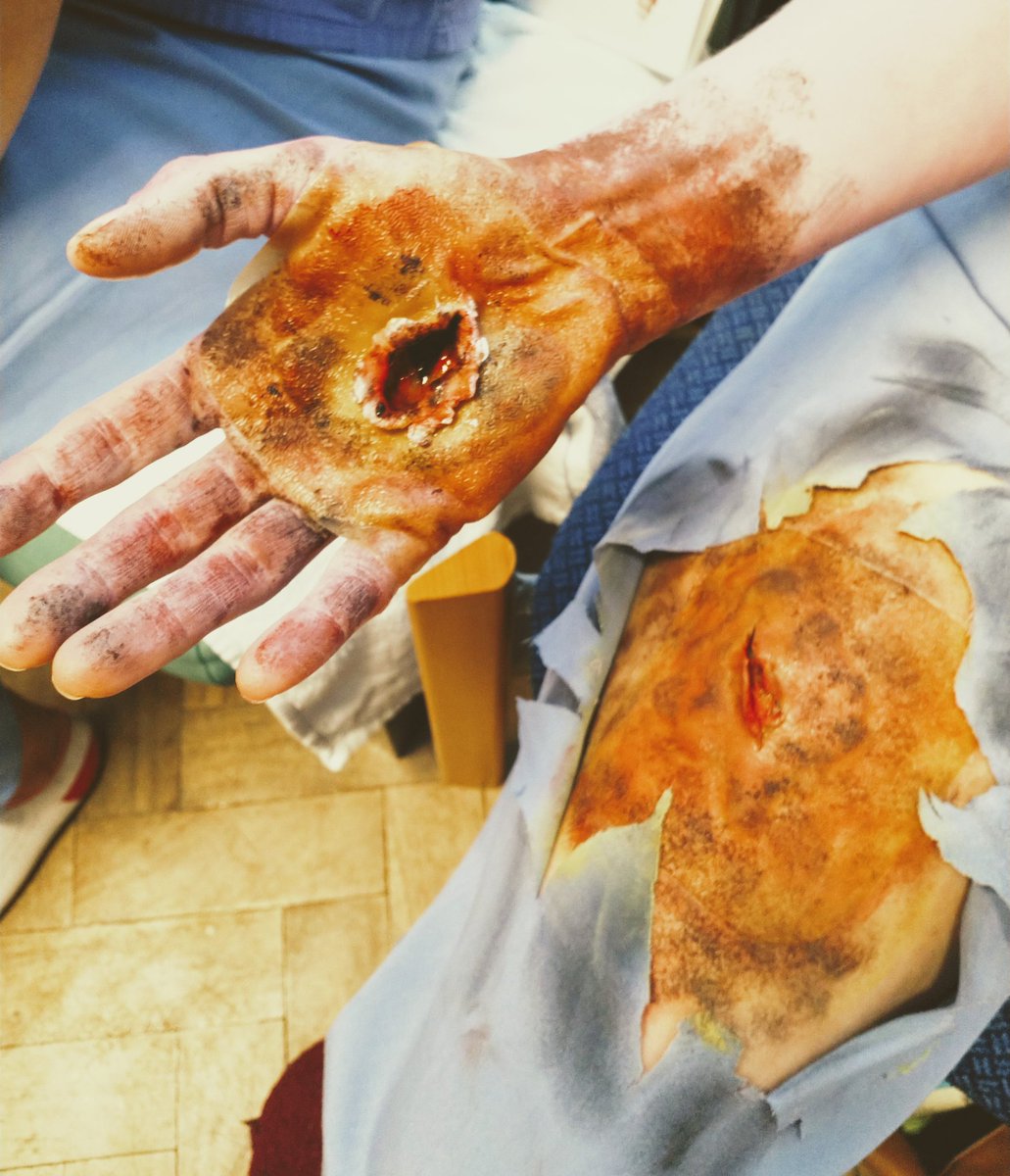 DeaksND's tweet photo. Yesterday's #AssociateCoOrdinator antics at #EMSB hosted at @qvh #EastGrinstead, supported by @BritishBurn. Wish this had been my #moulage effort!
#electricalburn #simulation #checktheurine #thinkfluids
Pictures posted with permission. https://t.co/S7V3IIL8mM