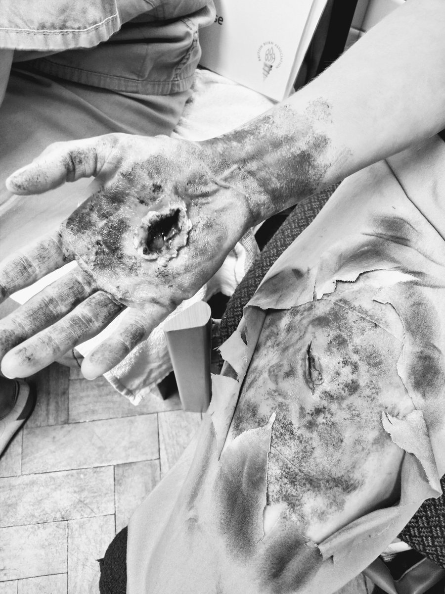 DeaksND's tweet photo. Yesterday's #AssociateCoOrdinator antics at #EMSB hosted at @qvh #EastGrinstead, supported by @BritishBurn. Wish this had been my #moulage effort!
#electricalburn #simulation #checktheurine #thinkfluids
Pictures posted with permission. https://t.co/S7V3IIL8mM