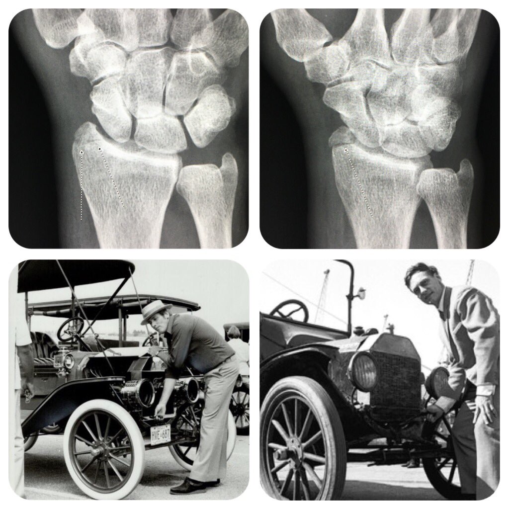 William Morrison, MD on X: "Radial styloid fracture, also called the  chauffeur fracture due to injuries resulting from hand cranks on old cars!  [also called 'backfire fracture' or Hutchinson fracture]  https://t.co/RIu68S5rf5" /