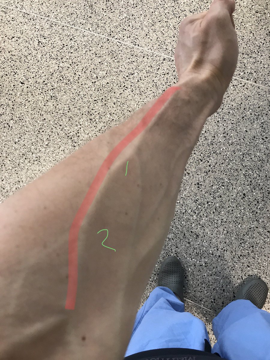dr_tgro's tweet image. Looking to teach #residents #USguided #IVplacement start with #cephalicVein from 1 to 2
