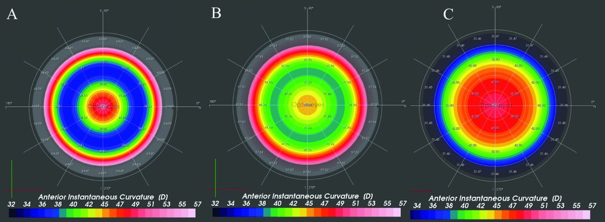 JRSJournal's tweet photo. Sequential customized therapeutic keratectomy yields significant improvements in CDVA, total higher order aberrations, and topographic irregularity indices with no significant change in mean #refraction or pachymetry @ric_vinciguerra https://t.co/aTxGWFAg2z https://t.co/lPugUi5kLC