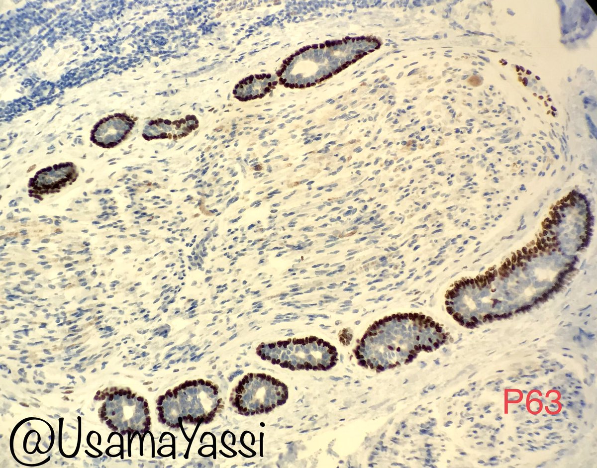 UsamaYassi's tweet photo. Classic case of adenoid cystic carcinoma showing perineural invasion with P63 immunostain. #classicfriday @UTMB_Pathology https://t.co/Rz2XrowWxm