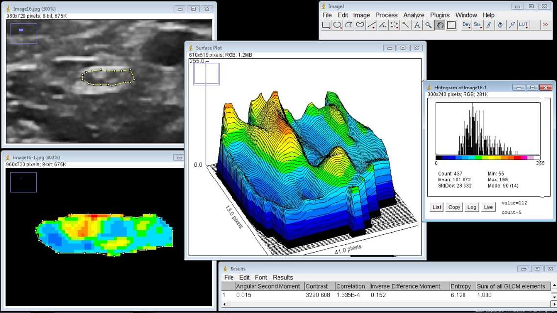 muptherapy's tweet photo. Buscamos información en el nervio. La resolución actual ya lo permite.  Biomarcadores ecográficos en #ELA #als #biomarkers
@muptherapy @ecofistem
#Quantitative #Ultrasound #image #ecografia #nervio
@Jacinto_MP @malenadelbano @GeyRivers @UMU @Nebrija @UCAM_Investiga @ECOFISTEM https://t.co/gK6q6yD8qe