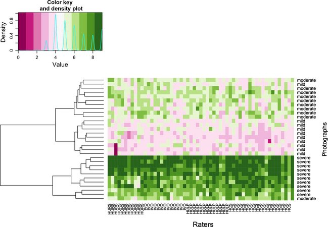 Facial Angiofibroma Severity Index (FASI): reliability assessment of a new tool developed to measure severity and responsiveness to therapy in tuberous sclerosis-associated facial angiofibroma
onlinelibrary.wiley.com/doi/10.1111/ce…