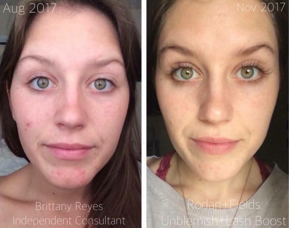 amyzsenai's tweet image. Unblemish: my saving grace and it did wonders for Brittany, too! Check out her flawless skin and amazing lashes!! Let 2018 be the beginning of healthy, beautiful and makeup free skin! #RodanAndFields #Unblemish #RFLashBoost #MakeupFree #LifeChangingSkincare