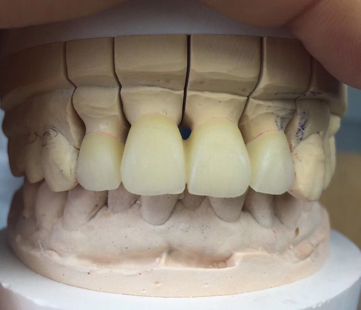 TOP_dentallab's tweet photo. Anterior bridge work by us💕 waiting to be finished! #topdental #topdentallab #veneers #dentistry #dental #dentallab #dentalbridge #dentaltechnician #madeinchina #outsourcing #anteriors #crowns #ceramic #porcelain https://t.co/G0dH4QovjK