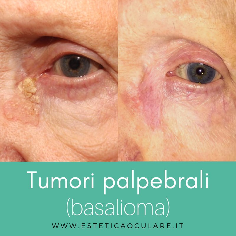 MigliardiRenata's tweet photo. Tumori palpebrali (basalioma)
-
https://t.co/Qk2eZTvHbG
#eyelid #eyelidcancer #cancer #tumori #tumoridellepalpebre #palpebre #sunexposure #biohair #lightcomplexion #blueeyes #tumor #cancro #eyes #occhio #occhi #basalomia #slow #painlessgrowth #eyesepecialist #specialista https://t.co/MZTG1MEzio
