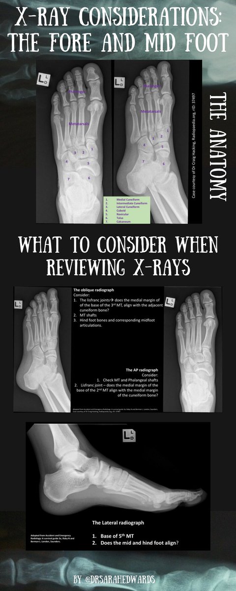 #footxray #minorinjuries #anatomy #foamed X-ray considerations for the Foot. @MIforEM by @drsarahedwards #EM