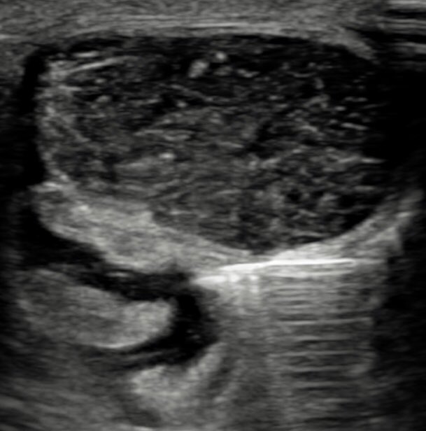 CotswoldMri's tweet photo. High volume #injections for #Achilles and #patellar #tendinosis - no need for #steroid - the higher volume is thought to break up the cycle of inflammation 

The picture below shows an #ultrasound guided #injection of the #Achilles #tendon, which has some patchy #calcification https://t.co/VRH8W4hYZd