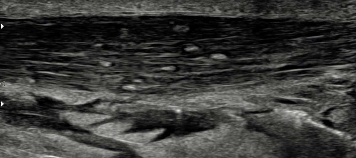 CotswoldMri's tweet photo. High volume #injections for #Achilles and #patellar #tendinosis - no need for #steroid - the higher volume is thought to break up the cycle of inflammation 

The picture below shows an #ultrasound guided #injection of the #Achilles #tendon, which has some patchy #calcification https://t.co/VRH8W4hYZd