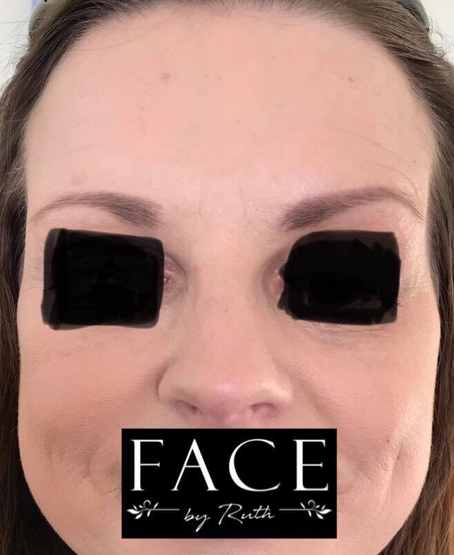 FACEbyRuth's tweet photo. A fabulous, natural and smoothing effect achieved from wrinkle relaxing injections in a highly dynamic client.  #facebyruth #aesthetics #beyourself https://t.co/5IFrleI3Zq