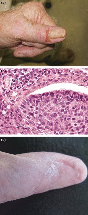 Basal cell carcinoma masquerading as habit tic
onlinelibrary.wiley.com/doi/10.1111/j.…
BCC can mimic various dermatological conditions such as granulation tissue in venous leg ulcers chronic dermatitis, paronychia, infection, trauma and pyogenic granuloma. BCC of the nail unit is rare.