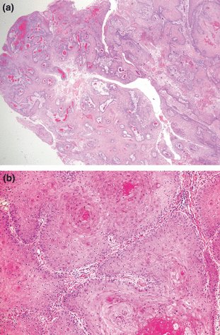 Giant verrucous lesion on the scalp
onlinelibrary.wiley.com/doi/10.1111/j.…
What's your diagnosis?