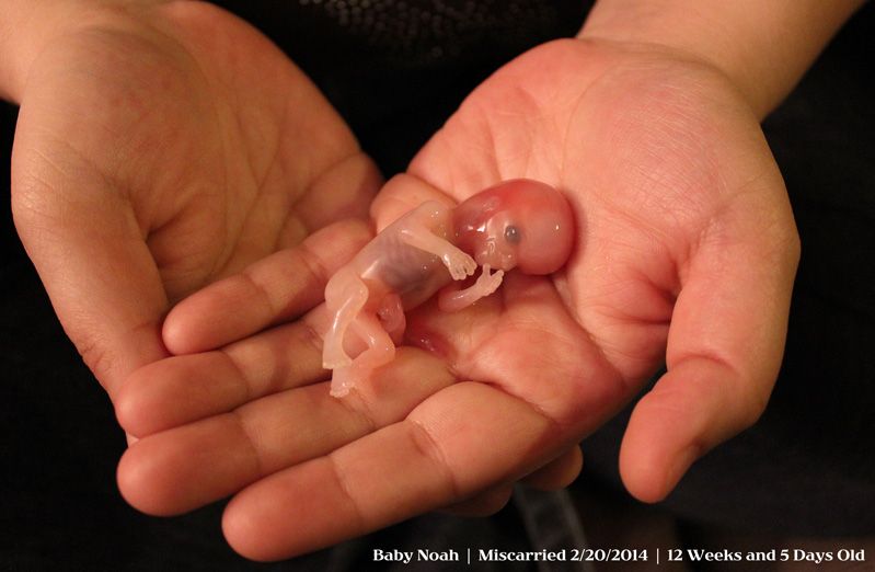 Picture Of Baby Miscarried At 12 Weeks Saves Unborn Baby From Abortion Lifenews Com Scoopnest