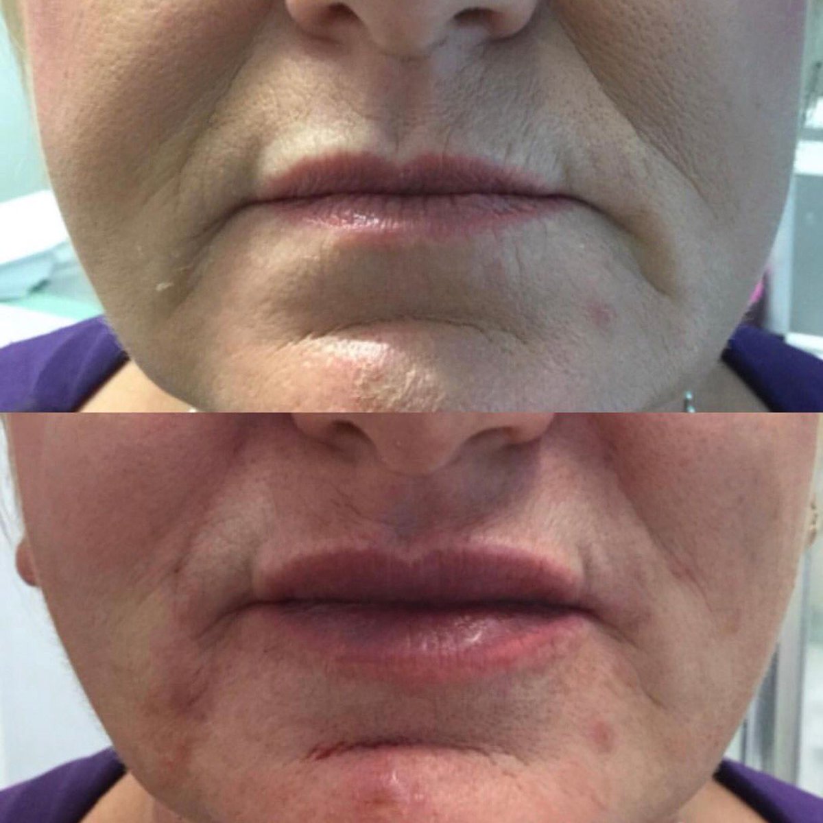 1ml of #dermalrevolution used for the natural looking result. Although subtle, definition and volume have still been achieved and we love an effective yet subtle result! Thanks to buff.ly/2oMUiEO for sharing tour result with us! #thedermalrevolution #aesthetics #Dermal