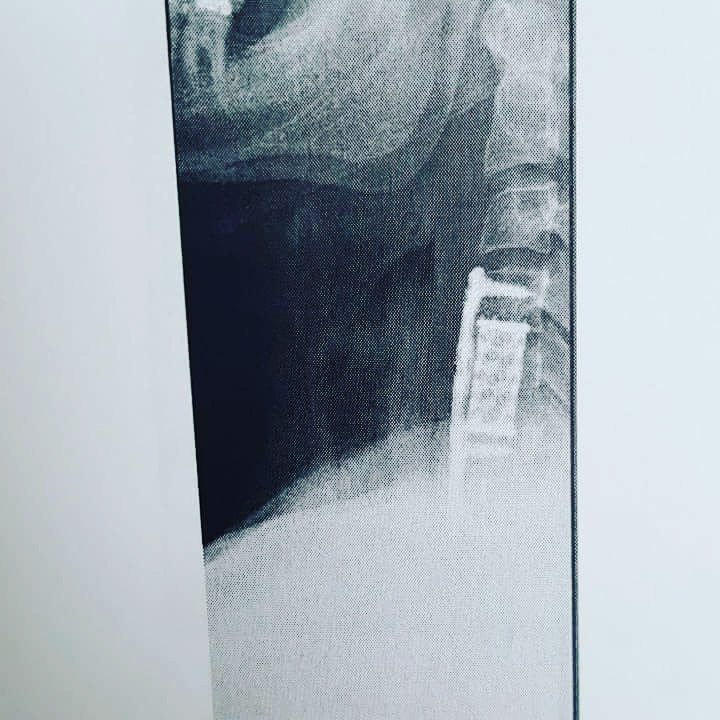 Surgery was a success. Time to recover and get back to getting fit. #workout #fitness #surgery #inspired #metalAF